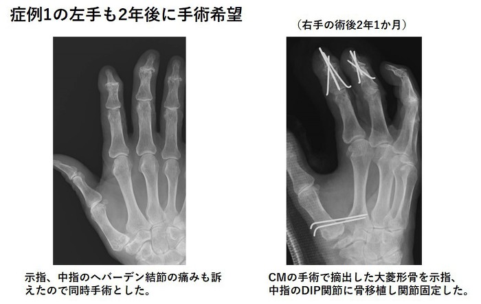示指、中指のへバーデン結節の痛みも訴えたので同時手術とした。CMの手術で摘出した大菱形骨を示指、中指のDIP関節に骨移植し関節固定した。
