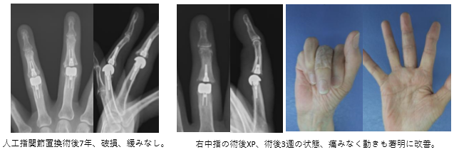 人工指関節置換術後7年、破損、緩みなし。 右中指の術後XP、術後3週の状態、痛みなく動きも著明に改善。