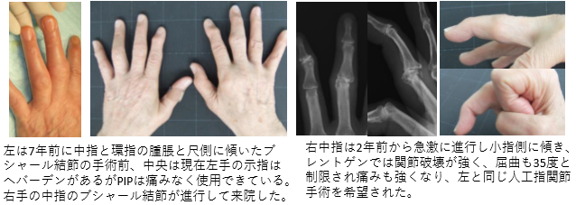 左は7年前に中指と環指の腫脹と尺側に傾いたブ シャール結節の手術前、中央は現在左手の示指は へバーデンがあるがPIPは痛みなく使用できている。 右手の中指のブシャール結節が進行して来院した。
右中指は2年前から急激に進行し小指側に傾き、 レントゲンでは関節破壊が強く、屈曲も35度と 制限され痛みも強くなり、左と同じ人工指関節 手術を希望された。