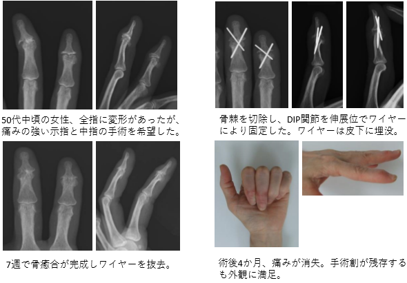 へ バーデン 結節 を 治す に は