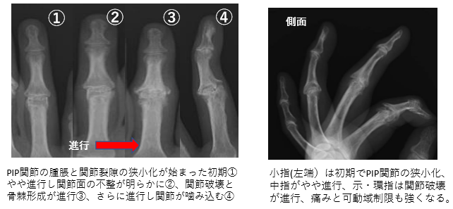小指(左端）は初期でPIP関節の狭小化、 中指がやや進行、示・環指は関節破壊 が進行、痛みと可動域制限も強くなる。① PIP関節の腫脹と関節裂隙の狭小化が始まった初期① やや進行し関節面の不整が明らかに②、関節破壊と 骨棘形成が進行③、さらに進行し関節が噛み込む④