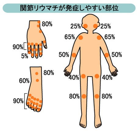 関節リウマチが発症しやすい部位