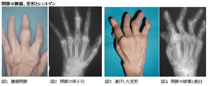 関節の腫脹、変形とレントゲン