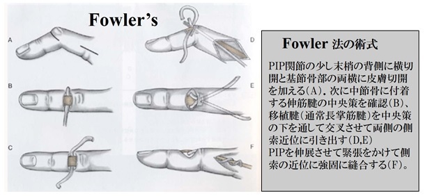 Fowler法の術式