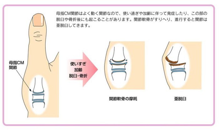 CM関節に発生する変形性関節症