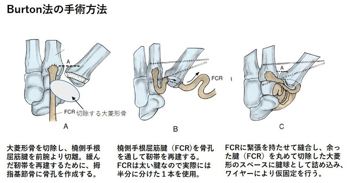 Burton法の手術方法