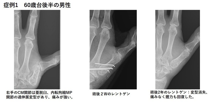 左手のCM関節は亜脱臼、内点拘縮MP関節の過伸展変形があり、痛みが強い。術後2年で変形消失、痛みもなく握力も回復した