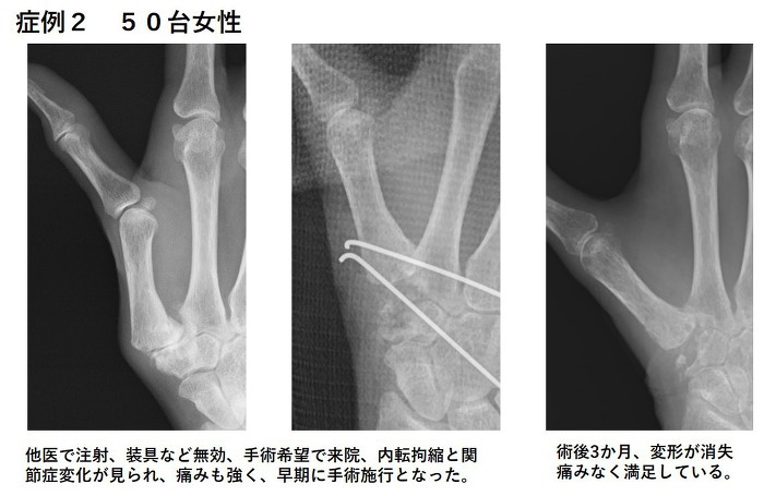 他医で注射・装具など無効、手術希望で来院、内点拘縮と関節症変化が見られ、痛みも強く、早期に手術施行となった。術後3ヶ月、変形が消失、痛みなく満足している。