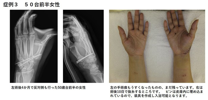 左の手術痕も薄くなったものの、まだ残っています。右は10日で抜歯するところ。ピンは皮膚内に埋め込まれているので装具を作成し入浴可能。