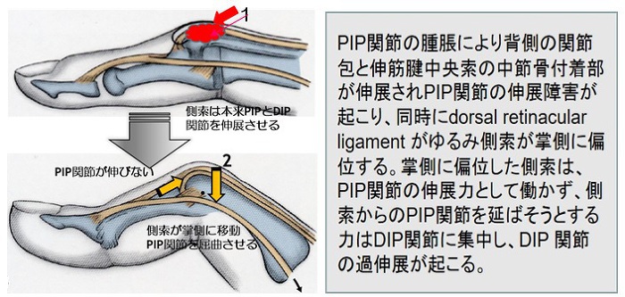 ボタン穴変形の発生機序