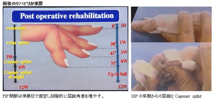 術後のリハビリが重要