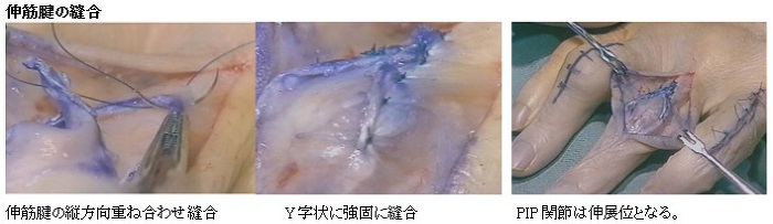 伸筋腱の縫合