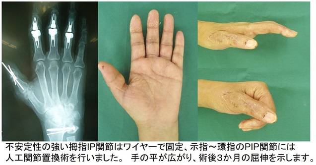 不安定性の強い拇指IP関節はワイヤーで固定、示指～環指のPIP関節には人工関節置換術を行いました。手の平が広がり、術後3ヶ月の屈伸を示します。