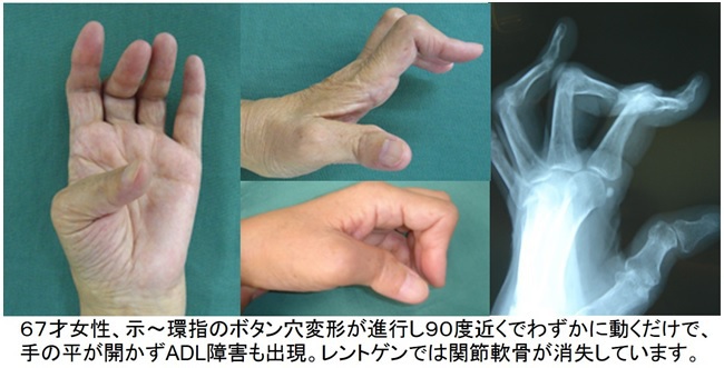 人工指関節置換術：示～環指のボタン穴変形が進行し、90度近くでわずかに動くだけで手の平が開かず、ADL障害も出現。レントゲンでは関節軟骨が消失しています。