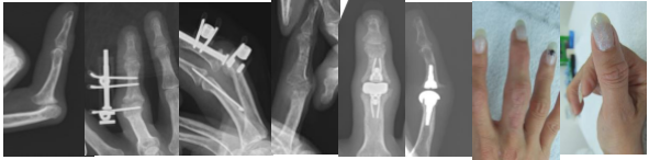 リウマチによる中指強度屈曲拘縮に対する人工関節手術