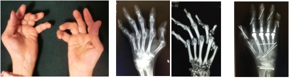 リウマチ尺側偏位に対する人工関節手術