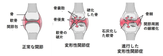 変形性関節症の病態