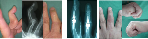 リウマチによる中指スワンネック変形に対する人工関節手術