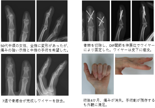 50代中頃の女性、全指に変形があったが、痛みの強い示指と中指の手術を希望した。
骨棘を切除し、DIP関節を伸展位でワイヤーにより固定した。ワイヤーは皮下に埋没。7週で骨癒合が完成しワイヤーを抜去。術後4か月、痛みが消失。手術創が残存するも外観に満足。