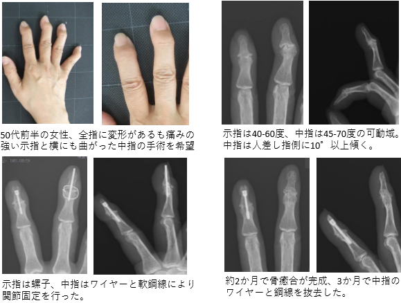 50代前半の女性、全指に変形があるも痛みの強い示指と横にも曲がった中指の手術を希望。示指は40‐60度、中指は45‐70度の可動域。中指は人差し指側に10°以上傾く。示指は螺子、中指はワイヤーと軟鋼線により関節固定を行った。約2か月で骨癒合が完成、3か月で中指のワイヤーと鋼線を抜去した。