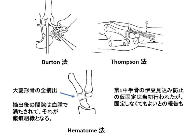 図７．関節形成術術